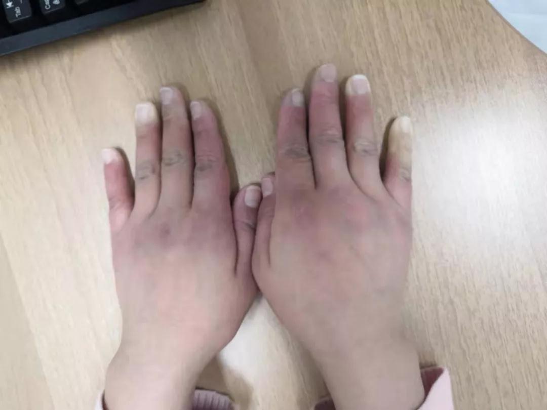 “手指、腳趾發(fā)白、發(fā)紫……”這些“小毛病”千萬別大意