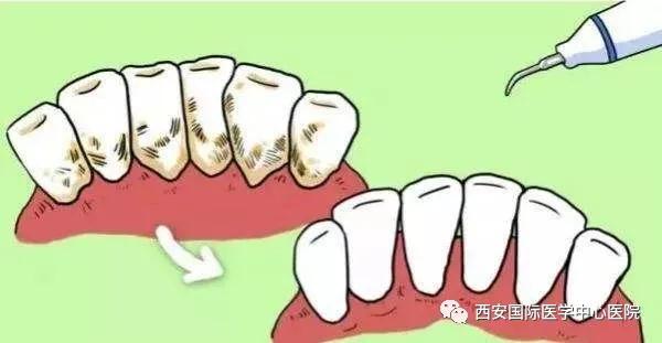 【科普】牙齒上的黃斑好難看，三招告訴你如何預(yù)防氟斑牙