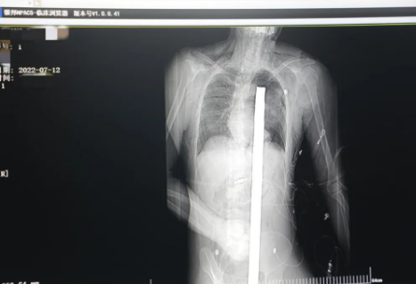 1.2米長的鋼筋貫穿男子胸腹！情況極度危險......