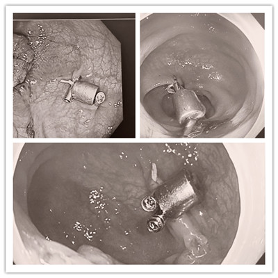 消化病醫(yī)院內(nèi)外科聯(lián)合開展3例“磁環(huán)預(yù)標記輔助腹腔鏡結(jié)、直腸癌根治術(shù)”