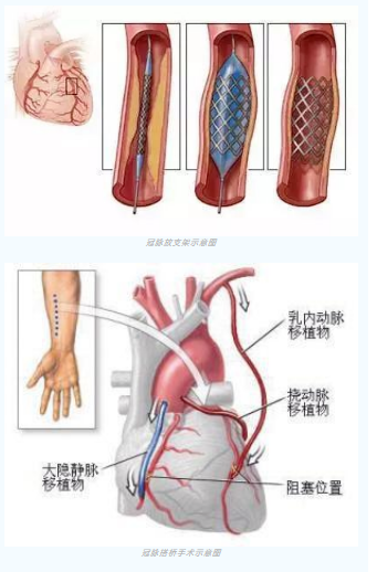 魚與熊掌不可兼得？冠脈雜交手術(shù)一站式解決問題