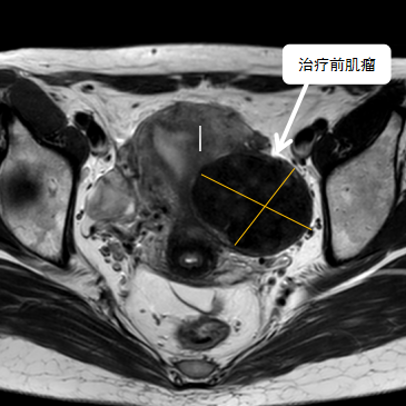 保子宮、保留生育功能—磁波刀治療子宮肌瘤