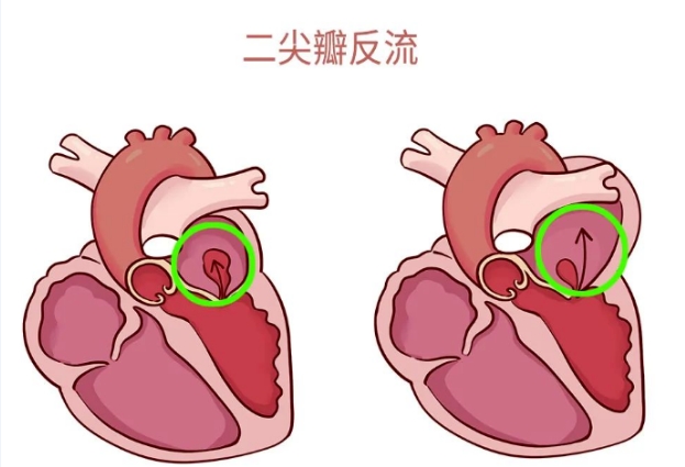 體檢報告里的心臟瓣膜返流，你讀懂了嗎？